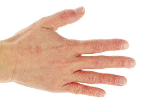 Eczema Dermatitis on Back of Hand and Fingers 