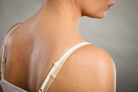 Health problem, skin diseases. Young woman showing her itchy back with allergy rash urticaria...