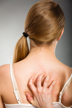 Health problem, skin diseases. Young woman scratching her itchy back with allergy rash