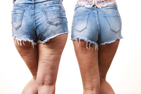 Comparison of female legs thighs with and without cellulite. Skin problem, body care, overweight and dieting concept.の写真素材