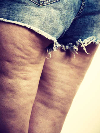 Woman legs thighs with cellulite skin problem. Body care, overweight and dieting concept.の写真素材