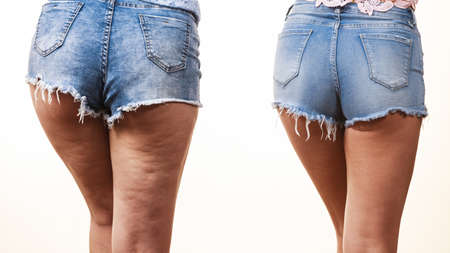 Comparison of female legs thighs with and without cellulite. Skin problem, body care, overweight and dieting concept.の写真素材