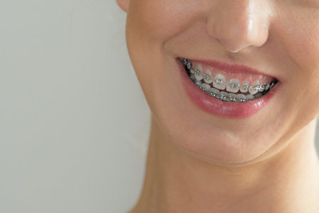 Dentist and orthodontist concept. Closeup of woman smile showing teeth with blue braces