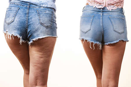 Comparison of female legs thighs with and without cellulite. Skin problem, body care, overweight and dieting concept.の写真素材