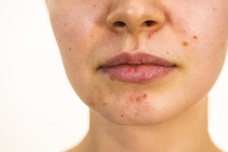 Young woman showing her face with acne and moles, dry lips. Teen girl no make up with red spots on her chin. Health problem, skin diseases.の写真素材