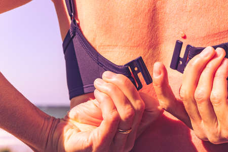 Caucasian woman back and shoulders skin hurt from sun burn. Severely burned skin, red tanned bodyの写真素材