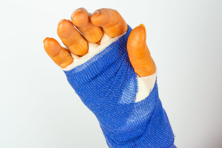 freshly operated hand with blue bandage and disinfectant orange fingers