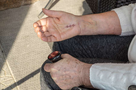 Hand with scar from a carpal tunnel syndrome operationの写真素材
