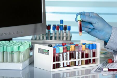 hand holding tube with blood sample analysis in the laboratory / scientist with a tube of blood in front of a computer screenの写真素材