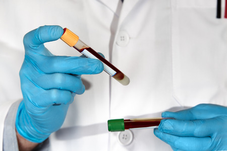 doctor examining two tubes with blood samples in his hands  / hands doctor holding blood tube in the...