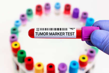Blood tube for Study of Tumor Marker test in biochemistry lab. doctor with blood tube labeled with Tumor marker for analysis of cancer biomarkers testの写真素材