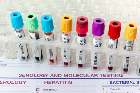 Laboratory tray with collection of blood testing sample tubes for Serology analysis. Rack of tubes with blood samples from patients in the Serology test labの写真素材
