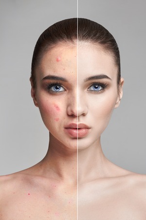 Pimples and acne on the woman's face before and after. Cosmetics to remove pimples and blackheads. Natural natural skin skin. Beautiful woman face closeup, dermatologyの写真素材