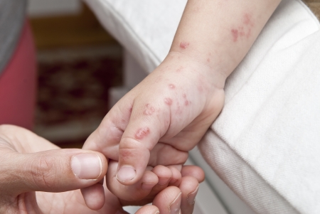 Blisters caused by herpes zoster in the hand and arm of a child の写真素材