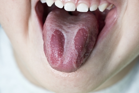Geographic tongue disease in a young child.の写真素材