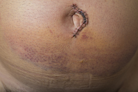 Umbilical hernia repair surgery in an adult manの写真素材