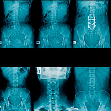 x-ray image lumbar and cervical  spine