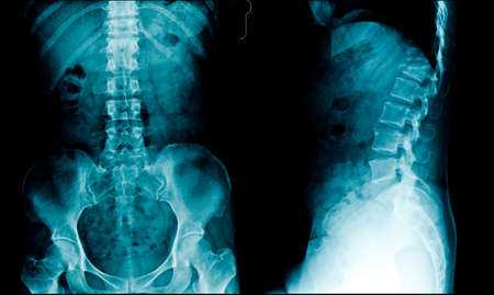 x-ray image lumbar spine frontal and lateral viewの写真素材