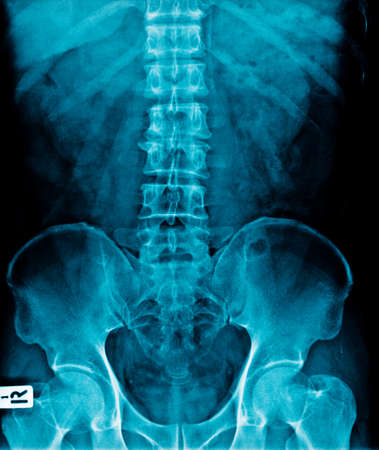 good quality x-ray image lumbar spineの写真素材