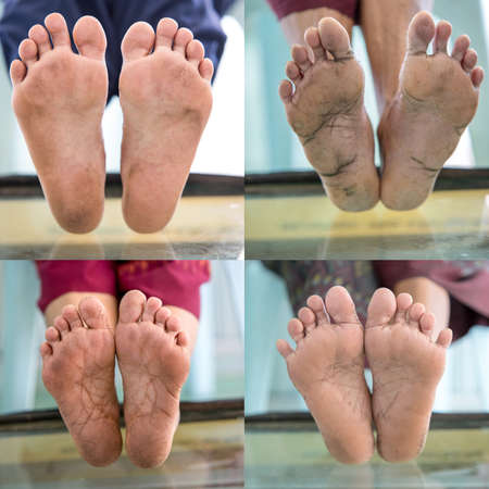 Diabetic foot collection, foot screen in diabetes patientの写真素材