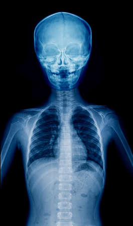 X-ray child upper part of body, hight quality film of childの写真素材
