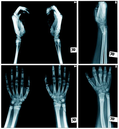 collection of x-ray image, hand x-ray AP and laterl viewの写真素材