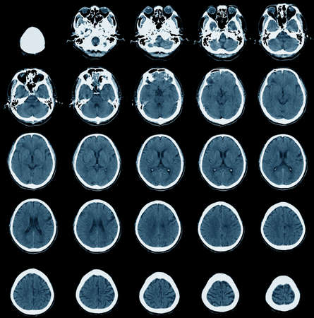 image of CT scan, x-ray computer of skull 