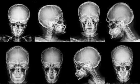 collection skull x-ray in gray tone