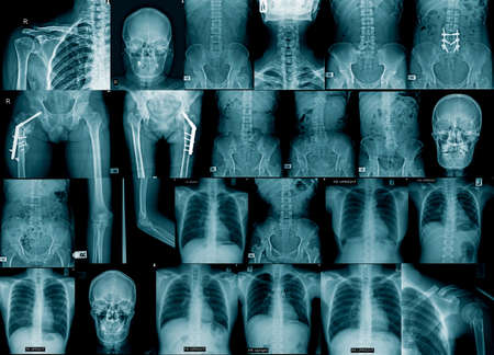 collection x-ray image chest, skull, hip replacement, spine fracture and fixed