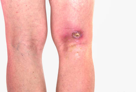 abcess popiteal area, inflammation of popiteal zone at right leg, infected wound righ knee bent