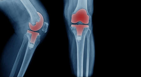 X-ray image, total knee artroplasty in blue toneの写真素材