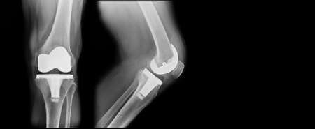 TKA x-ray, total knee replacement frontal and lateral viewの写真素材