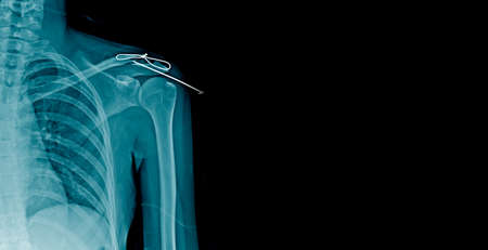 x-ray fracture clavicle with post op fixationの写真素材