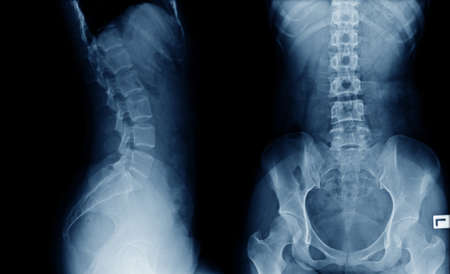 back x-ray image AP and lateral view in blue tone on black background