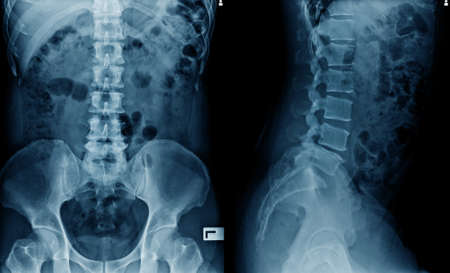 x-ray image of spine and hip joint AP/Lateral view