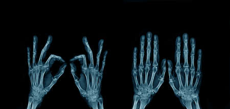 x-ray image hand and finger, action of hand and finger x-ray Image in blue tone on dark backgroundの写真素材