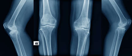 x-ray image of OA knee in blue toneの写真素材