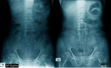lumbar spondylosis x-ray image AP and lateral view