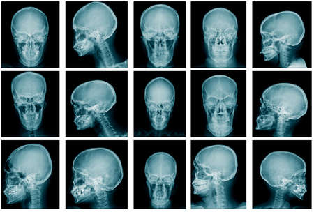collection skull x-ray image in blue tone