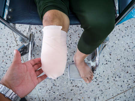 elastic bandaging in diabetes mellitus BK amputationの写真素材
