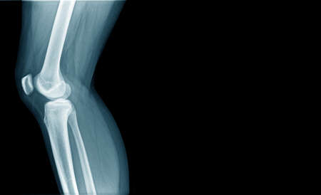 x-ray image og knee joint in blue tone with copy spaceの写真素材