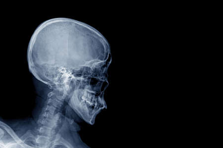 x ray human skull on black background lateral view