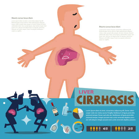 Liver Cirrhosis. infographic - vector illustrationのイラスト素材