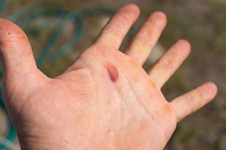 Blister in the middle of the palm, careless working, not good safetyの写真素材