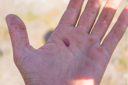 Blister in the middle of the palm, careless working, not good safetyの写真素材