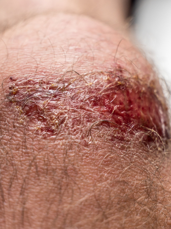 Grave on the knee after a bicycle crashの写真素材