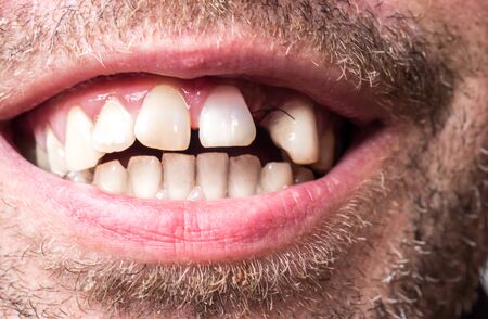 tooth gap after a cyst surgeryの写真素材
