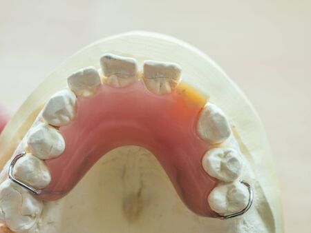 dental Tooth prosthesis