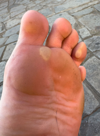 Blisters on the soles of the feet from hiking verticallyの写真素材