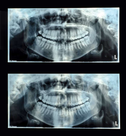 Simple panoramic dental x-rayの写真素材